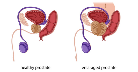 healthy and enlarged prostate illustration